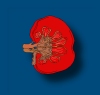 Diabetische Nephropathie