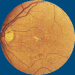 Diabetische Retinopathie